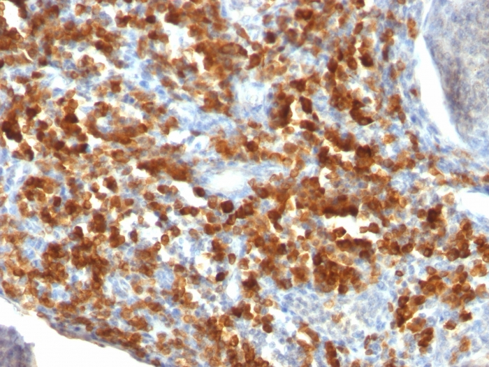 IHC-P analysis of human lymphoma tissue using GTX34560 CD79a antibody [IGA/515].