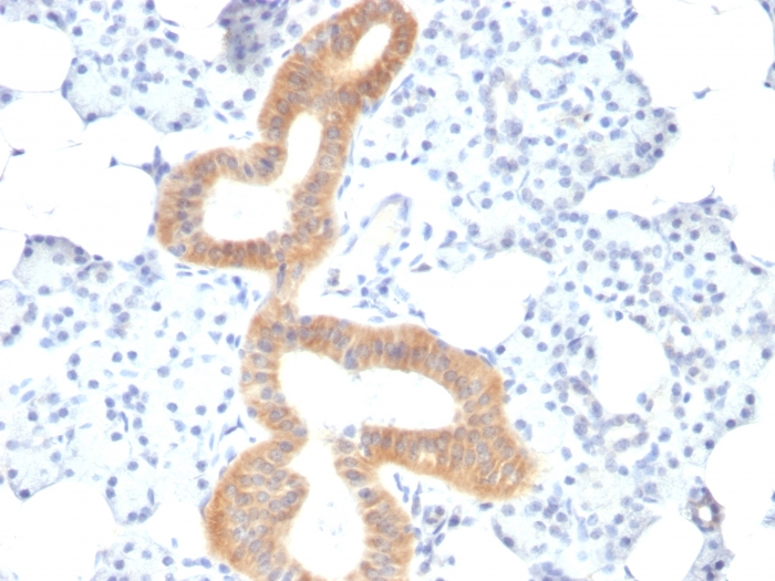 IHC-P analysis of human melanoma tissue using GTX34570 CD86 antibody [SPM600].