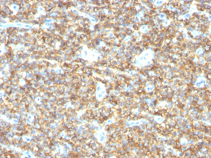 IHC-P analysis of human Ewings sarcoma tissue using GTX34576 CD99 antibody [HO36-1.1].