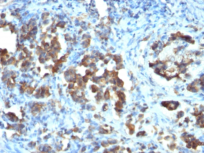 IHC-P analysis of human gastric carcinoma tissue using GTX34579 CDC20 antibody [CDC20/1102].