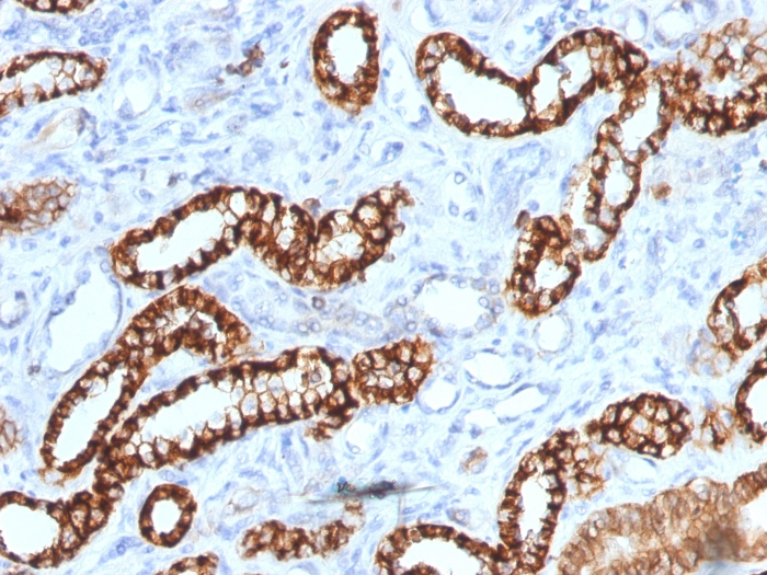 IHC-P analysis of human renal cell carcinoma tissue using GTX34582 CDH16 antibody [rCDH16/1071].