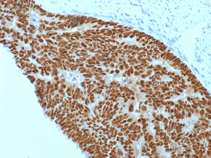 IHC-P analysis of human colon carcinoma tissue using GTX34585 CDX2 antibody [CDX2/1690].