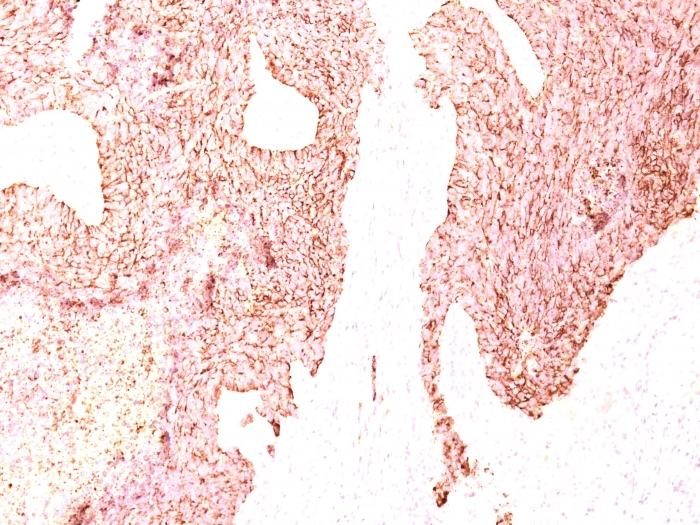 Formalin-fixed,paraffin-embedded human Small Cell Lung Carcinoma stained with Chromogranin A Monoclonal Antibody (LK2H10)