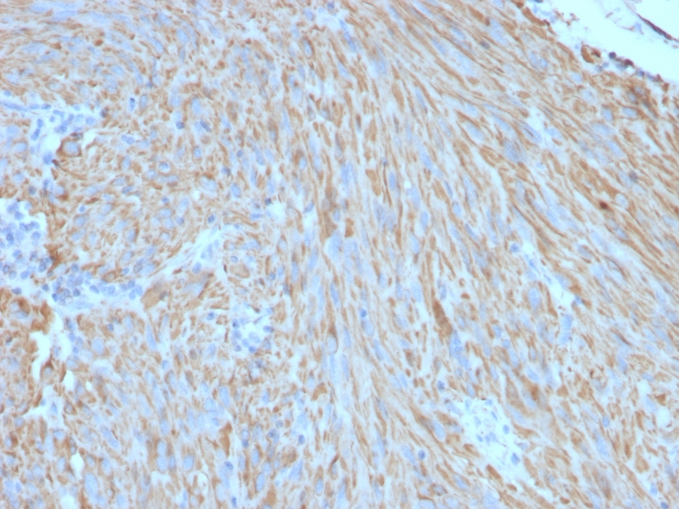 Formalin-fixed,paraffin-embedded human Gastrointestinal Stromal Tumor (GIST) stained with CD117 Monoclonal Antibody (C117/370).