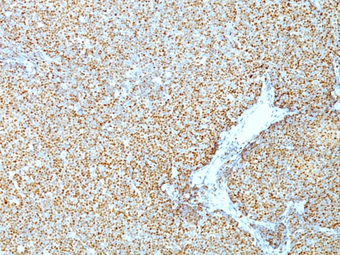 IHC-P analysis of human mantle cell lymphoma tissue using GTX34617 Cyclin D1 antibody [CCND1/809].