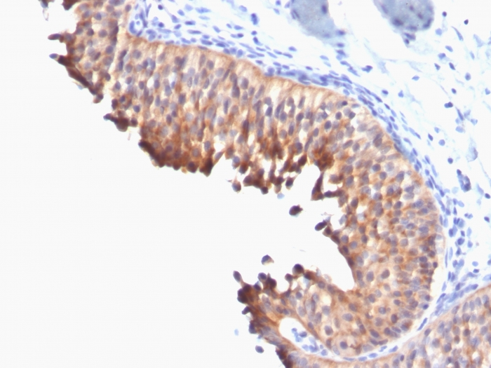 Formalin-fixed,paraffin-embedded human Bladder Carcinoma stained with Cytokeratin 10 Monoclonal Antibody (DE-K10).