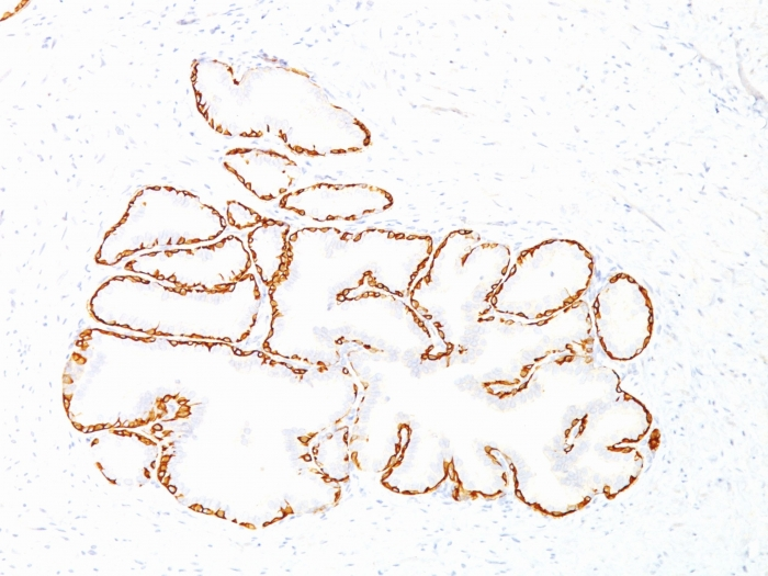 IHC-P analysis of human prostate carcinoma tissue using GTX34629 Cytokeratin 14 antibody [SPM263].