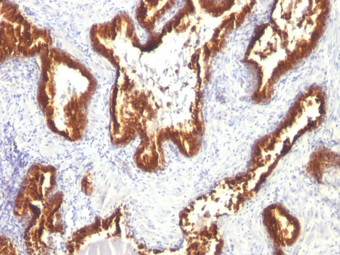 IHC-P analysis of human prostate carcinoma tissue using GTX34637 Cytokeratin 18 antibody [KRT18/1190].