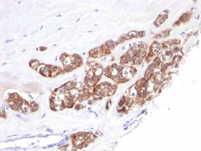 IHC-P analysis of human breast carcinoma tissue using GTX34640 Cytokeratin 18 antibody [SPM510].