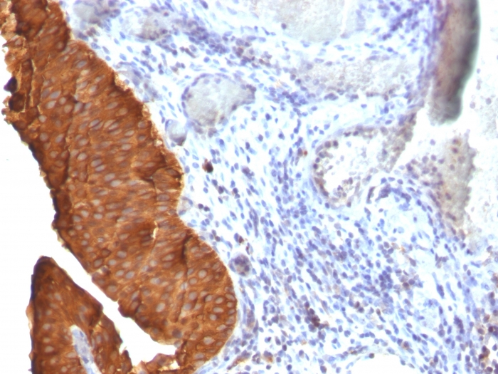 IHC-P analysis of human bladder carcinoma tissue using GTX34649 Cytokeratin 19 antibody [SPM561].