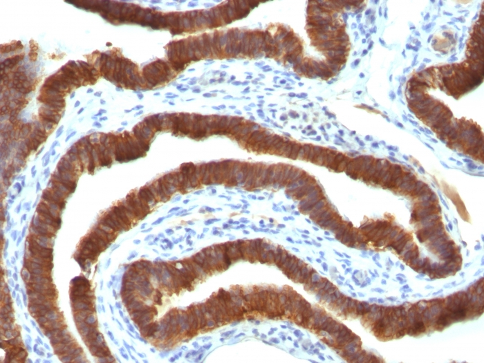 IHC-P analysis of human ovarian carcinoma tissue using GTX34652 Cytokeratin 19 antibody [Ks19.1].