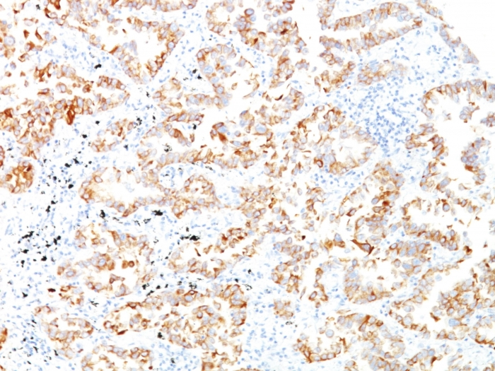 IHC-P analysis of human lung scc tissue using GTX34656 Cytokeratin 7 antibody [SPM270].