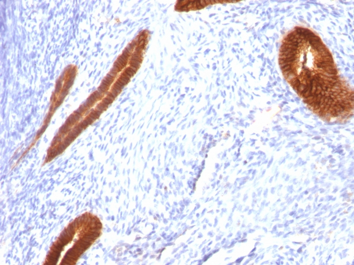 IHC-P analysis of human endometrial carcinoma tissue using GTX34659 Cytokeratin 7 antibody [KRT7/760].