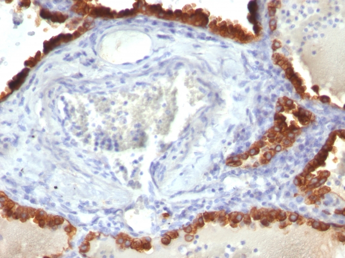 IHC-P analysis of human lung carcinoma tissue using GTX34659 Cytokeratin 7 antibody [KRT7/760].