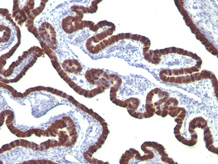 IHC-P analysis of human ovarian carcinoma tissue using GTX34659 Cytokeratin 7 antibody [KRT7/760].