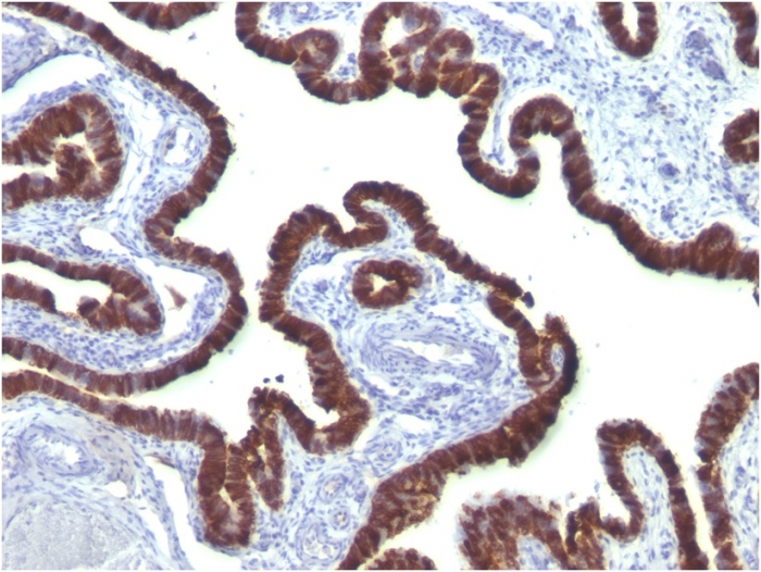 IHC-P analysis of human ovarian carcinoma tissue using GTX34662 Cytokeratin 7 antibody [OV-TL12/30].