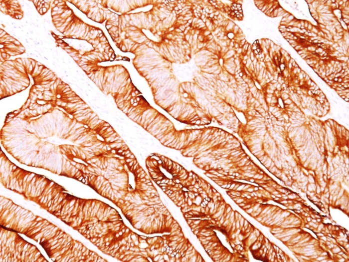 IHC-P analysis of human colon carcinoma tissue using GTX34663 Cytokeratin 8 antibody [H1].