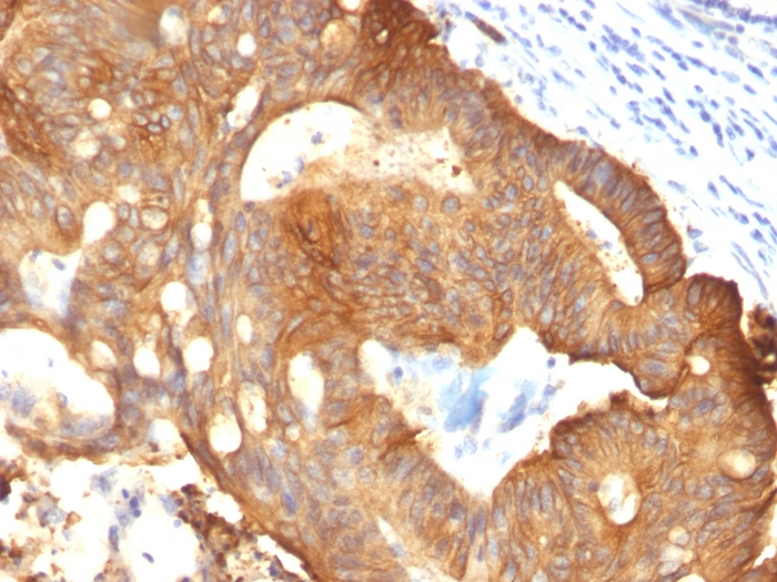 IHC-P analysis of colon carcinoma tissue using GTX34664 Cytokeratin 8 antibody [B22.1].