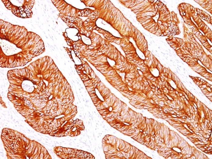 IHC-P analysis of human colon carcinoma tissue using GTX34666 Cytokeratin 8 antibody [K8/383].