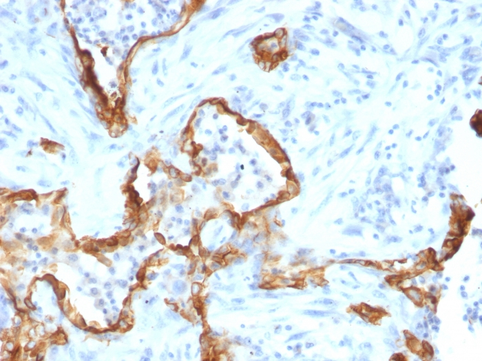 IHC-P analysis of human lung carcinoma tissue using GTX34668 Cytokeratin 8 antibody [SPM192].