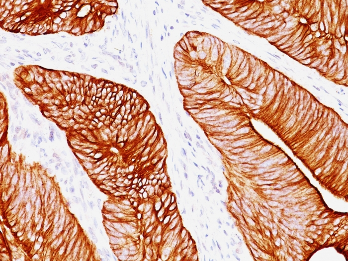 IHC-P analysis of human colon carcinoma tissue using GTX34670 Cytokeratin 8 antibody [K8.8].