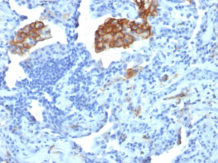 Formalin-fixed,paraffin-embedded human Lung Carcinoma stained with CD209 Monoclonal Antibody (C209/1781).