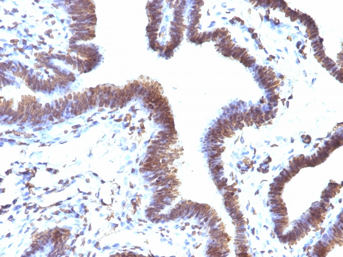 IHC-P analysis of human ovarian carcinoma tissue using GTX34689 EMI1 antibody [EMI1/1176].
