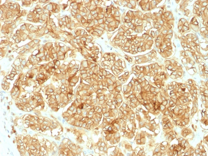 IHC-P analysis of human renal cell carcinoma tissue using GTX34690 EpCAM antibody.