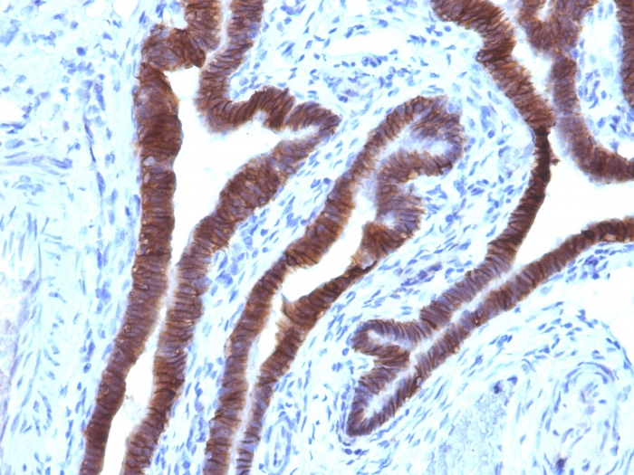 IHC-P analysis of human ovarian carcinoma tissue using GTX34691 EpCAM antibody [EGP40/1110].