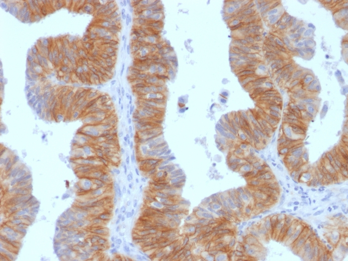 IHC-P analysis of human ovarian carcinoma tissue using GTX34696 EpCAM antibody [EGP40/1384].