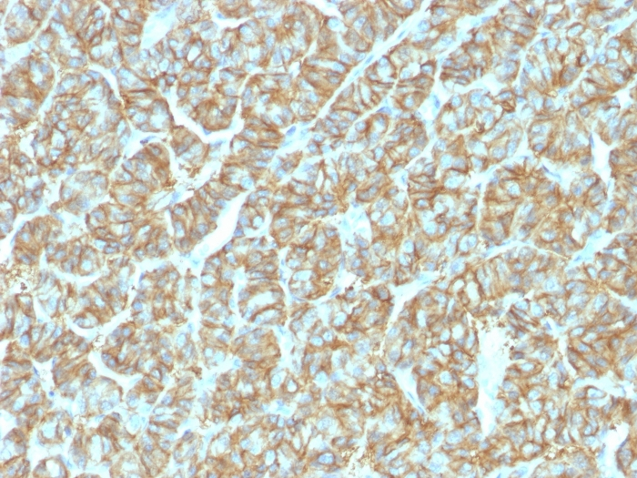 IHC-P analysis of human thyroid carcinoma tissue using GTX34707 EpCAM antibody [EGP40/1555R].
