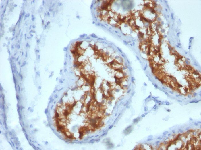 IHC-P analysis of human testicular carcinoma tissue using GTX34718 Fascin 1 antibody [FSCN1/417].