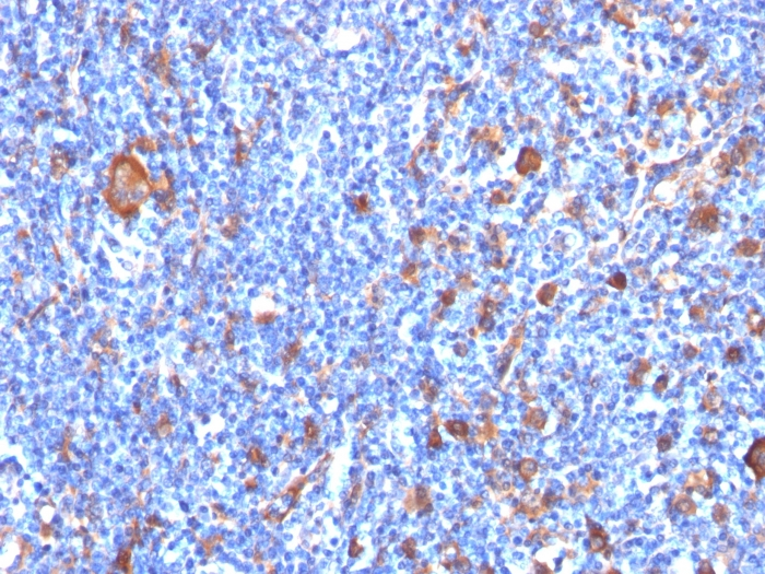 IHC-P analysis of human Hodgkins lymphoma tissue using GTX34718 Fascin 1 antibody [FSCN1/417].