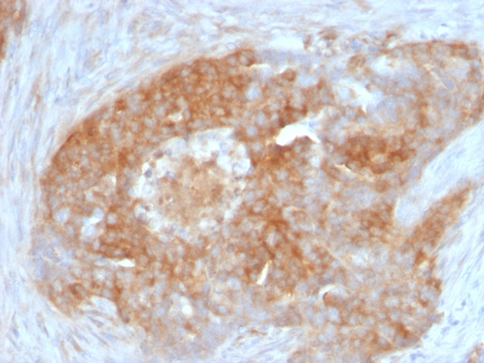 IHC-P analysis of human ovarian carcinoma tissue using GTX34718 Fascin 1 antibody [FSCN1/417].
