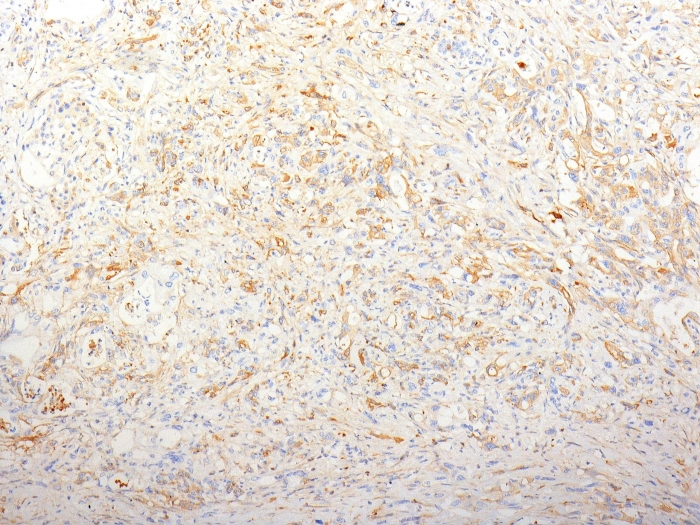 Formalin-fixed,paraffin-embedded human Pancreatic Adenocarcinoma stained with Fibronectin Monoclonal Antibody (TV-1).