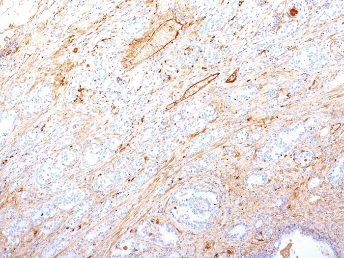 Formalin-fixed,paraffin-embedded human Pancreatic Adenocarcinoma stained with Fibronectin Monoclonal Antibody (SPM246).