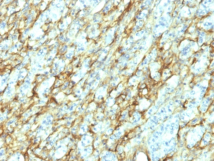 Formalin-fixed,paraffin-embedded human Renal Cell Carcinoma stained with Fibronectin Monoclonal Antibody (568).