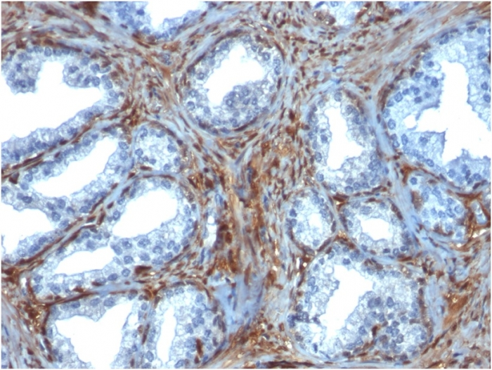 IHC-P analysis of human prostate carcinoma tissue using GTX34746 Galectin 1 antibody [GAL1/1831].