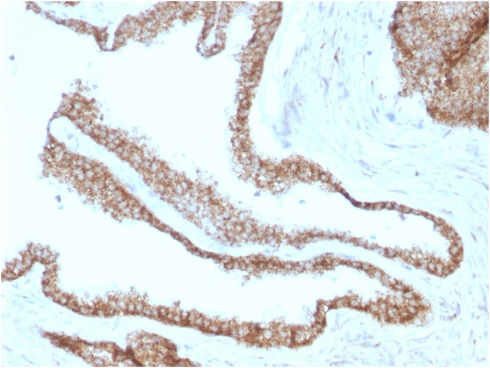 IHC-P analysis of human prostate carcinoma tissue using GTX34752 gamma Catenin antibody [CTNG/1664].
