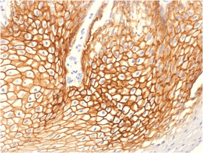 IHC-P analysis of human cervical carcinoma tissue using GTX34752 gamma Catenin antibody [CTNG/1664].