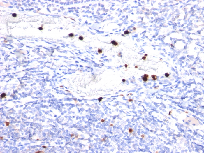 Formalin-fixed,paraffin-embedded human Tonsil stained with G-CSF Monoclonal Antibody (CSF3/900). Note specific cytoplasmic staining of granulocytes.