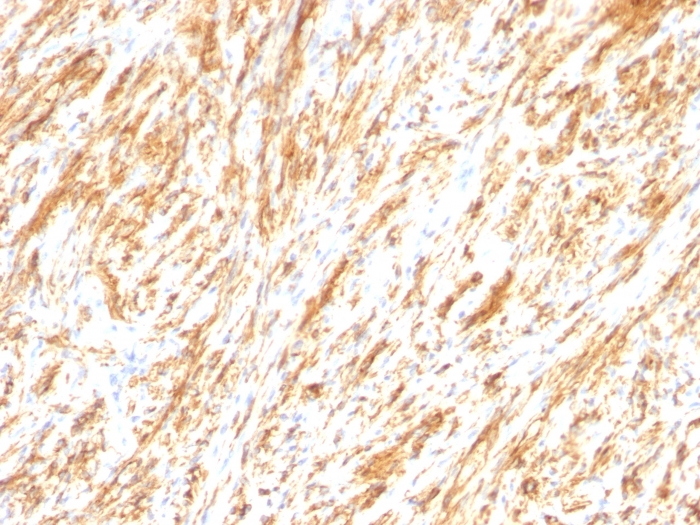 IHC-P analysis of human schwanoma tissue using GTX34756 GFAP antibody [SPM248].