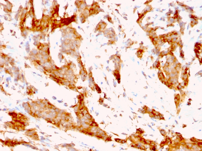 IHC-P analysis of human breast carcinoma tissue using GTX34771 GRP94 antibody [9G10.F8.2].