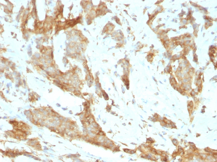 Formalin-fixed,paraffin-embedded human Breast Carcinoma stained with GRP94 Monoclonal Antibody (SPM249).