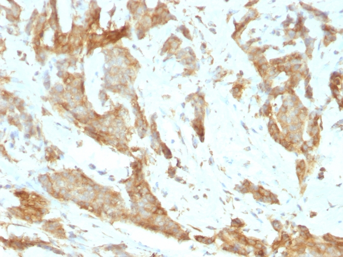 IHC-P analysis of human breast carcinoma tissue using GTX34772 GRP94 antibody [SPM249].