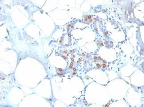 IHC-P analysis of human breast carcinoma tissue using GTX34782 HSP27 antibody [SPM252].