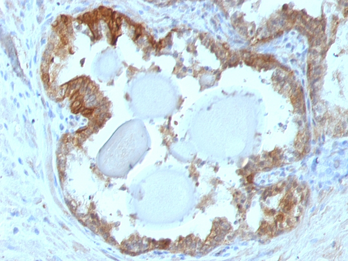 IHC-P analysis of human prostate carcinoma tissue using GTX34784 HSP27 antibody [G3.1].