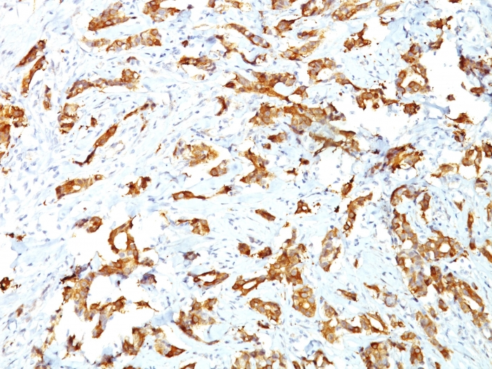 IHC-P analysis of human breast carcinoma tissue using GTX34784 HSP27 antibody [G3.1].