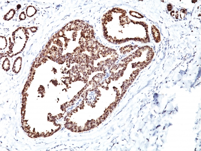 Formalin-fixed,paraffin-embedded human Breast Carcinoma stained with HSP60 Monoclonal Antibody (LK1)