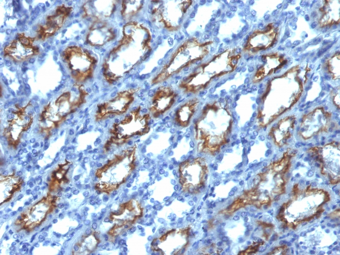 IHC-P analysis of human renal cell carcinoma tissue using GTX34794 Interferon gamma antibody [IFNG/466].